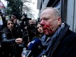 Journalist Thomas Jacobi spricht mit blutüberströmtem Gesicht in Mikrofone und Kameras
